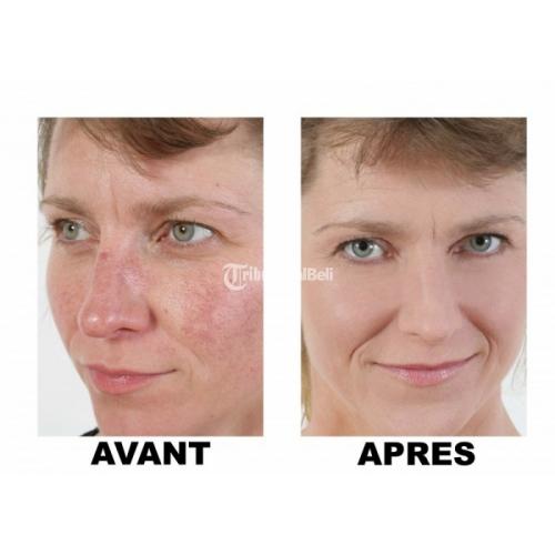 generische roaccutane