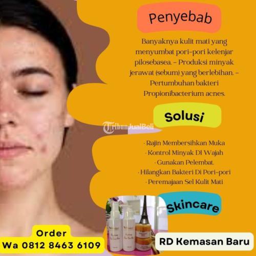 Cream Skincare RD Untuk Menghilangkan Jerawat Di Muka Dengan Cepat - Lebak