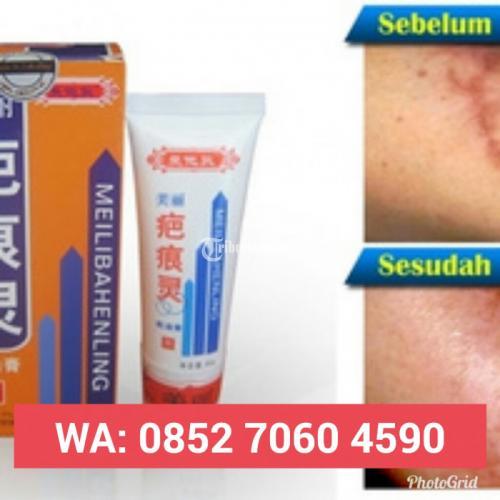 Cream Penghilang Bekas Luka Bakar Di Medan