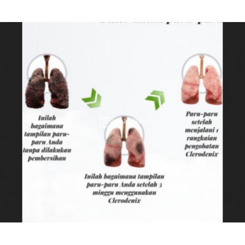 Clerodenix Obat Paru-paru Herbal BPOM Halal - Jakarta Pusat