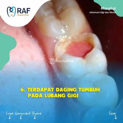 Klinik Gigi Di Malang | HP/WA: 0815-5544-4125