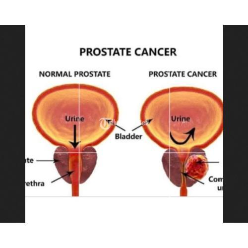 PROSTERO Paket 3 Botol Obat PROSTAT