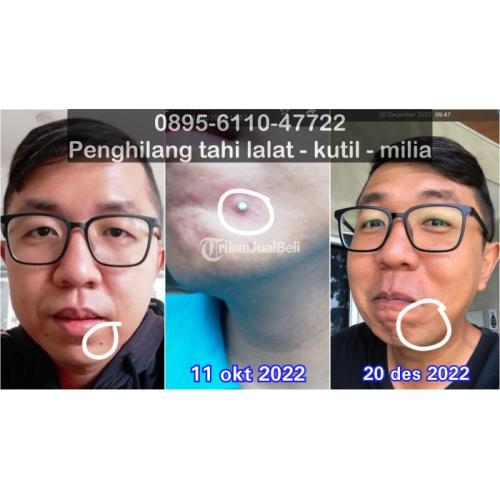 Obat Penghilang Tahi Lalat Tanpa Bekas - Bandung