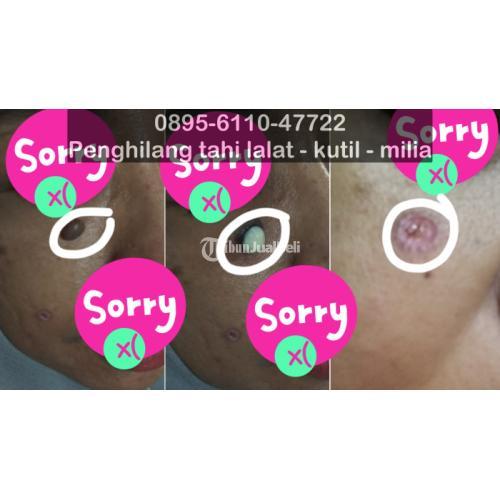 Obat Perontok Tahi Lalat - Bandung