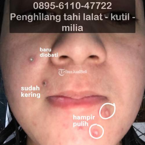 Salep Penghilang Tahi Lalat Yang Aman Terdekat - Bandung