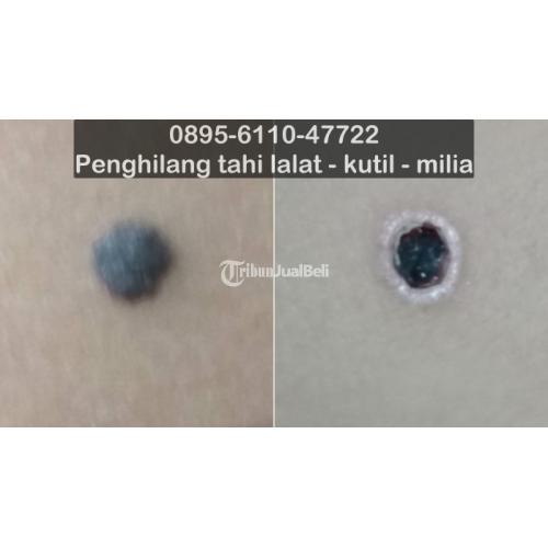 Salep Penghilang Tahi Lalat Yang Aman Terdekat - Bandung