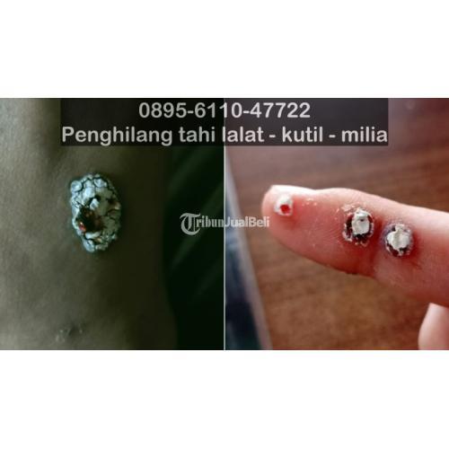 Salep Penghilang Tahi Lalat Yang Aman Terdekat - Bandung