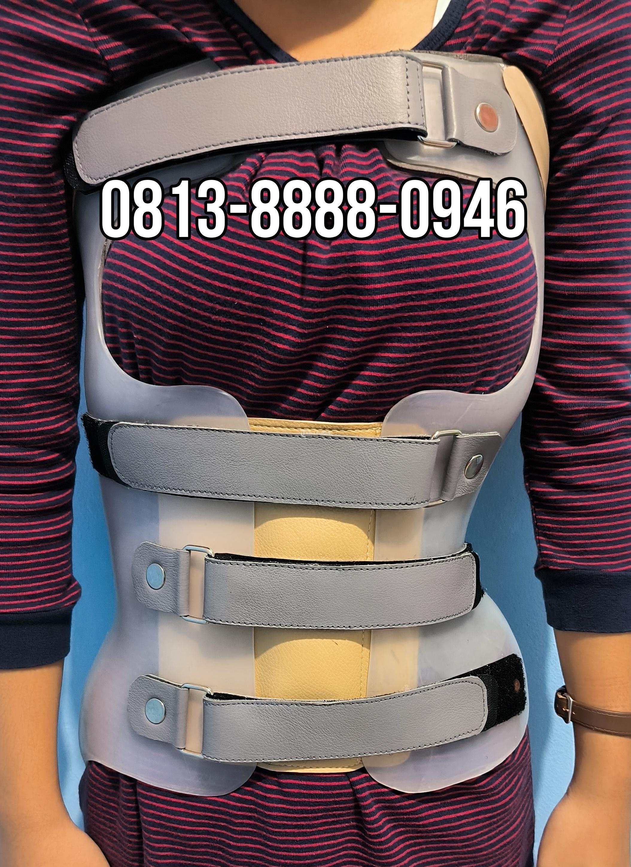 Jasa Pembuatan Korset Scoliosis