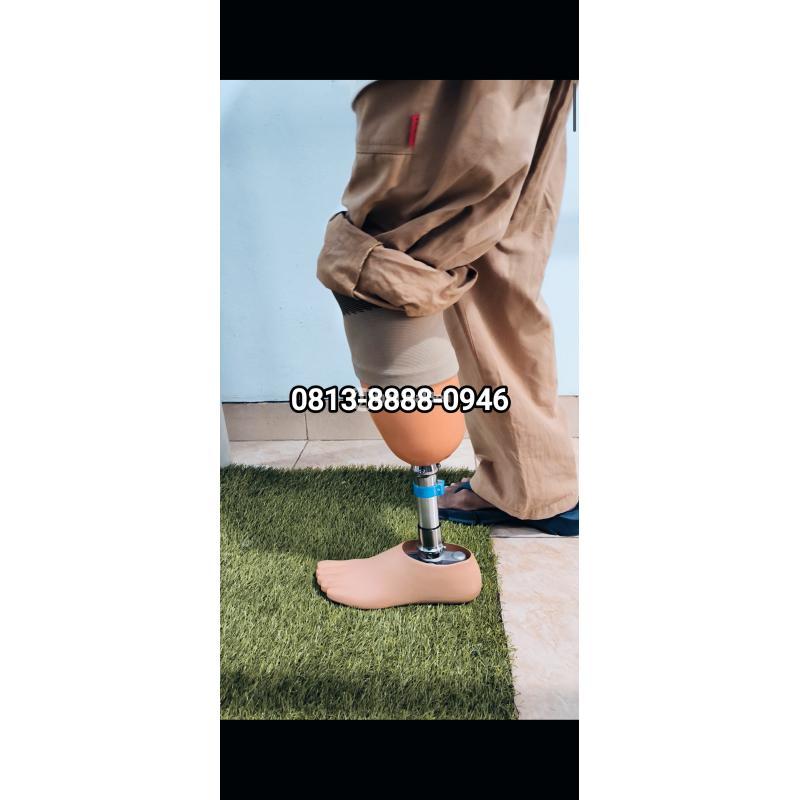 Pembuat Kaki Palsu Indramayu Sumedang Tasikmalaya Kuninga Banjarn Subang