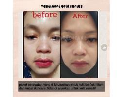 Perawatan Skincare Mengurangi Dari Flek Hitam Membandel Daviena Gold Series - Surabaya Jawa Timur