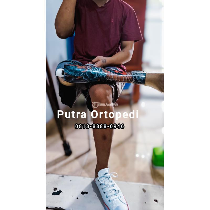 Kaki Palsu Atas Lutut Ditangani Tenaga Medis Profesional Berpengalaman 13 Tahun - Jakarta Utara