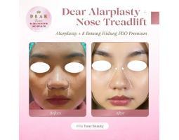 Alarplasty di Jombang Biar Hidung Tampak Lebih Mancung dan Proporsional - Klinik Kecantikan Jombang Dear Dream dr. Anangwib