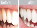 Tak Perlu Keluarkan Banyak Uang ke Dokter, Ini Cara Mudah & Praktis Hilangkan Plak di Gigi agar Kamu Tambah Pede Berpenampilan