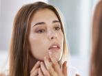 Jangan Percaya! 7 Mitos Tentang Jerawat Ini Sama Sekali Tidak Benar, Nomor 5 Paling Sering Dipercaya
