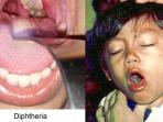 Waspada, Difteri akan Cepat Menular Apabila Kondisi Tubuh Seperti Ini