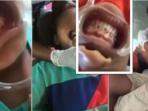 Viral! Bocah Ini Memasangkan Kawat Gigi Ke Temannya! Kalo Infeksi? Serem!