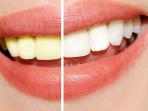 Tak Usah Ke Dokter Gigi Untuk Lakukan Pemutihan dan Pembersihan Gigi, Cukup Lakukan Cara Alami Ini Saja. Terjamin!
