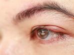 Yuk Kenali Penyebab Mata Bintitan dan Cara Menanggulanginya