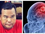 5 Kebiasaan Penyebab Stroke & Sering Disepelekan Seperti yang Dialami oleh Fahmi Bo