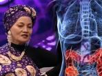 Deretan Makanan Penyebab Penyakit Kanker Usus yang Merenggut Nyawa Titi Qadarsih