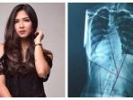 Kenali 4 Penyebab Skoliosis Seperti yang Diderita Jessica Mila