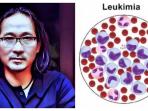 Kerap Diabaikan, Kenali Gejala Leukimia Seperti yang Dialami Musisi Senior Dian Poetra hingga Tutup Usia