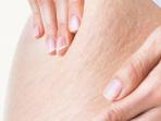 Stretchmark di Payudara? Atasi dengan 3 Cara Mudah Ini