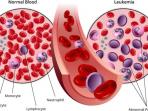 Cegah Penyakit Leukimia dengan Kebiasaan-Kebiasaan yang Simpel Ini