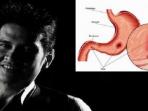 Banyak Seleb Meninggal Dunia Karena Asam Lambung, Ini 5 Cara Cegah Penyakit yang Kerap Diabaikan Itu