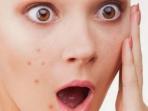 Dari Pizza Hingga Roti Putih, Deretan Makanan Ini Bisa Sebabkan Jerawat