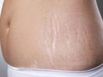 Malu Punya Stretch Mark di Kulit? Tenang, Ini 5 Cara Mengatasinya
