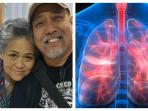 Tak Cuma Rokok, 4 Makanan Ini Juga Pemicu Besar Kanker Paru-Paru Seperti yang Diidap Istri Indro Warkop