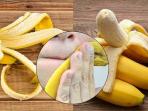 Cuma Modal Kulit Pisang, Begini Cara Mudah Hilangkan Jerawat 