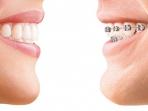 Tak Perlu Pakai Behel, Ini Metode Baru Meratakan Gigi 