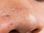 Trik Mudah Hilangkan Komedo Tanpa Facial Cuma Butuh Waktu Semalam Saja