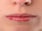 4 Hal Penyebab Bibir Kering dan Pecah-Pecah