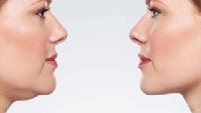 Double Chin Bisa Sebabkan Kematian? Simak Yuk Penjelasan Ahli