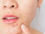Girls, Sebal Punya Jerawat Bruntusan? Nih 5 Bahan Alami untuk Mengatasinya