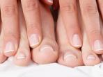8 Penyebab Kuku Tangan dan Kaki Menghitam Hanya Di Ujung Jari, Salah Satunya Kanker!