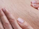 Mudah Didapatkan, Inilah 5 Bahan Alami yang Terbukti Ampuh Hilangkan Stretch Mark