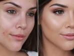 Perhatikan 3 Hal Ini Jika Ingin Menutupi Jerawat dengan Makeup