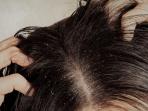 Selain Gatal, Ini 5 Risiko Buruk dari Menyepelekan Masalah Ketombe pada Rambut 