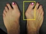Bunion - Kenali Penyebab Pergeseran Tulang Ibu Jari Kaki yang Sering Dialami Para Wanita