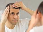 5 Cara Mudah Hindari Kebotakan Dini