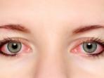 Kenali Penyebab Umum Mata Memerah Saat Pakai Softlens