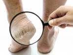 Cara Mudah Atasi Telapak Kaki Kering dan Pecah-pecah dengan Bahan Alami
