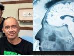 Waspadai Tanda Tak Kasat Mata Sebelum Anda Terserang Kanker Otak Seperti yang Dialami Agung Hercules