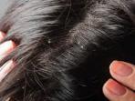 Jamur Menjadi Penyebab Utama Rambut Ketombean? Simak yuk Ulasannya