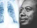 Jarang Disadari, Kenali Gejala Kanker Paru-paru yang Sebabkan Ketua BNPB Sutopo Meninggal Dunia