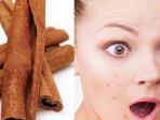 Punya Masalah Jerawat? Atasi yuk Hanya dengan Masker Kayu Manis